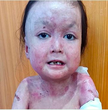 Shamila's wounds and bandages
