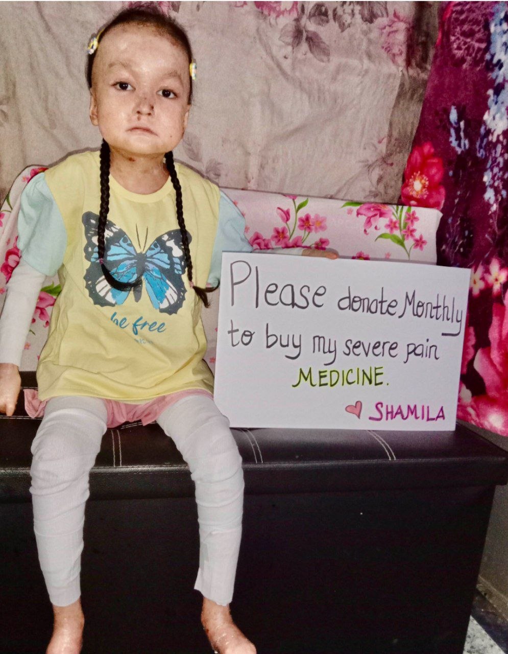Shamila, 7 years old with Epidermolysis Bullosa
